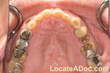 dental-implants-17293before1thumb